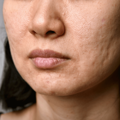 Female client with acne scarring