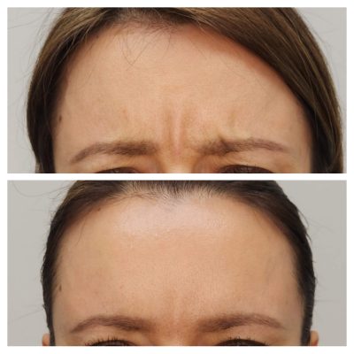 Before and After, Botox frown line treatment