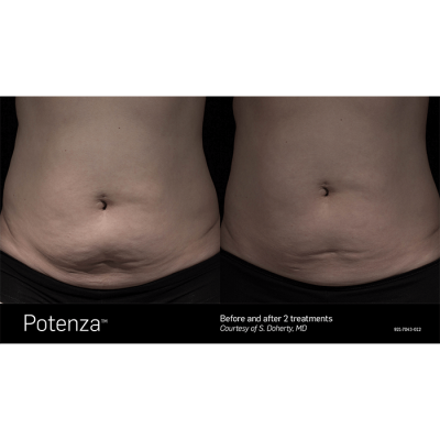 Potenza Microneedling Before and After