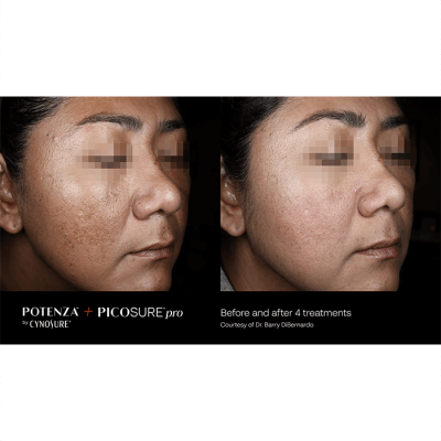 Potenza Microneedling Before and After_Milton