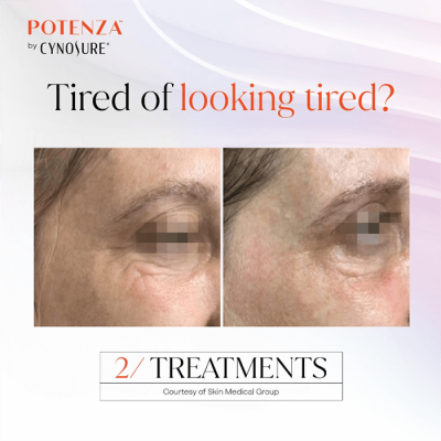 Potenza RF Microneedling before and after