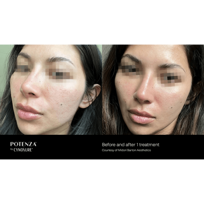 acne scars, before and after, milton